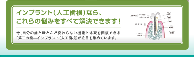 インプラント（人工歯根）なら、これらの悩みをすべて解決できます！今、自分の歯とほとんど変わらない機能と外観を回復できる「第三の歯―インプラント（人工歯根）が注目を集めています。