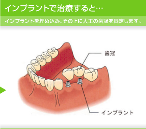 インプラントで治療すると… インプラントを埋め込み、その上に人工の歯冠を固定します。
