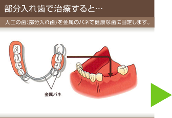 部分入れ歯で治療すると… 人工の歯(部分入れ歯)を金属のバネで健康な歯に固定します。