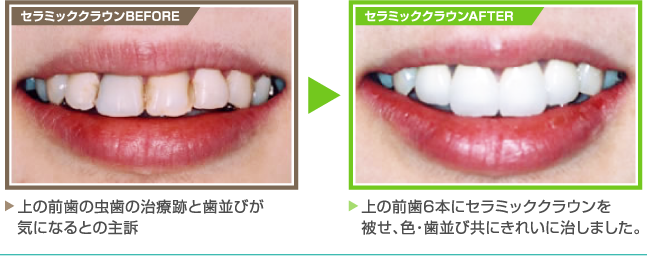 【セラミッククラウンBEFORE】上の前歯の虫歯の治療跡と歯並びが気になるとの主訴 【セラミッククラウンAFTER】上の前歯6本にセラミッククラウンを被せ、色・歯並び共にきれいに治しました。
