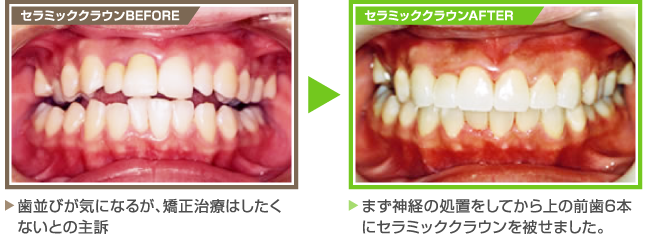 【セラミッククラウンBEFORE】歯並びが気になるが、矯正治療はしたく
ないとの主訴 【セラミッククラウンAFTER】まず神経の処置をしてから上の前歯6本にセラミッククラウンを被せました。