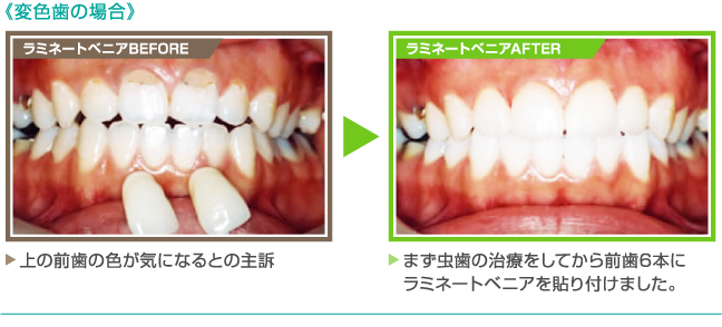 《変色歯の場合》【ラミネートベニアBEFORE】上の前歯の色が気になるとの主訴 【ラミネートベニアAFTER】まず虫歯の治療をしてから前歯6本にラミネートベニアを貼り付けました。