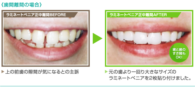 《歯間離間の場合》【ラミネートベニア正中離間BEFORE】上の前歯の隙間が気になるとの主訴 【ラミネートベニア正中離間AFTER】元の歯より一回り大きなサイズのラミネートベニアを2枚貼り付けました。