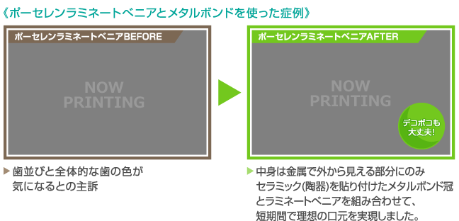 《ポーセレンラミネートべニアとメタルボンドを使った症例》【ポーセレンラミネートベニアBEFORE】歯並びと全体的な歯の色が気になるとの主訴 【ポーセレンラミネートベニアAFTER】中身は金属で外から見える部分にのみセラミック(陶器)を貼り付けたメタルボンド冠とラミネートべニアを組み合わせて、短期間で理想の口元を実現しました。