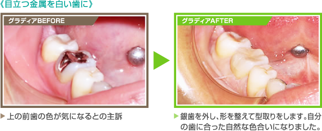 《目立つ金属を白い歯に》【グラディアBEFORE】上の前歯の色が気になるとの主訴 【グラディアAFTER】銀歯を外し、形を整えて型取りをします。自分の歯に合った自然な色合いになりました。