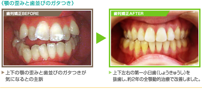 《顎の歪みと歯並びのガタつき》【歯列矯正BEFORE】上下の顎の歪みと歯並びのガタつきが気になるとの主訴 【歯列矯正AFTER】上下左右の第一小臼歯(しょうきゅうし)を抜歯し、約2年の全顎動的治療で改善しました。