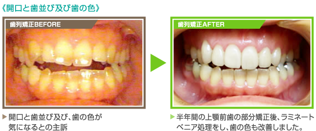 《開口と歯並び及び歯の色》【歯列矯正BEFORE】開口と歯並び及び、歯の色が気になるとの主訴 【歯列矯正AFTER】半年間の上顎前歯の部分矯正後、ラミネートベニア処理をし、歯の色も改善しました。