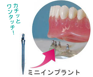 ミニインプラント カチッとワンタッチ!